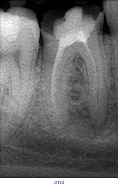 endodoncja